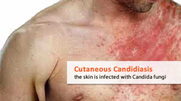 Symptoms Of Candida Albicans Infection Candida Cure Center